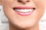 Dental-Bonding