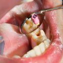 Timespan of a Root Canal Treatment in Whiteville, NC_FI