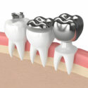 Maintaining Good Oral Hygiene After Getting A CEREC Crown_FI