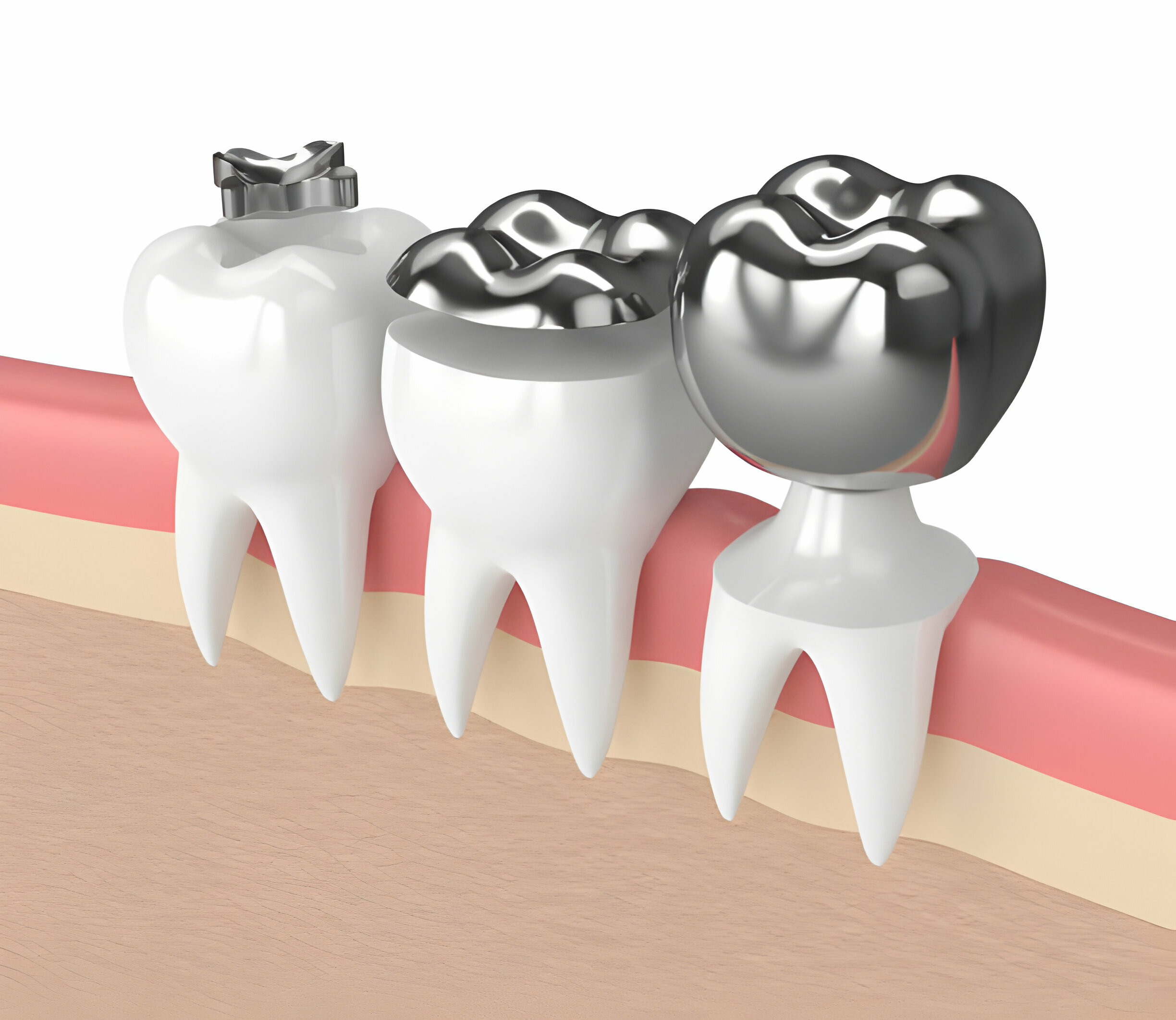 Maintaining Good Oral Hygiene After Getting A CEREC Crown_FI
