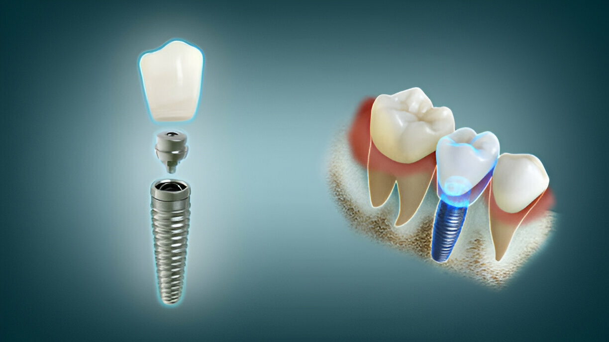 Dental Implants vs. Other Tooth Replacement Options – Expert Advice from Carolina Coast Family Dentistry in Shallotte, NC_2