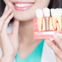 dental implants