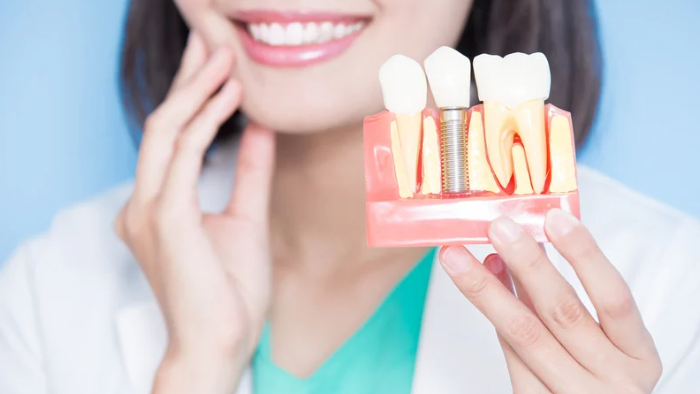 dental implants