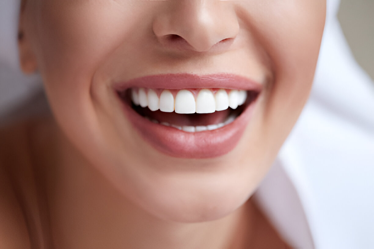 The Benefits of Combining Teeth Whitening and Veneers for a Flawless Smile in Shallotte, NC