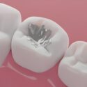 Ceramic Onlays vs. Traditional Fillings: Which is More Durable? Insights from Carolina Coast Family Dentistry in Shallotte, NC_FI