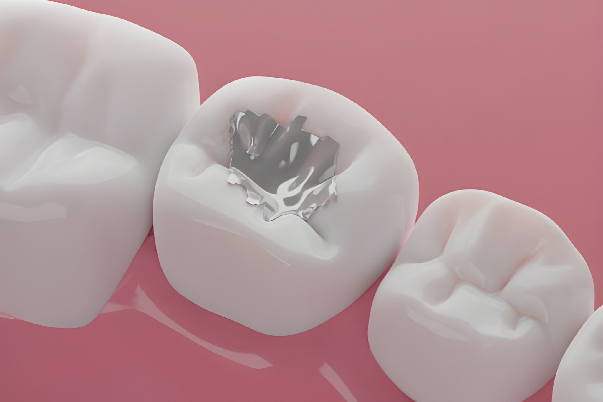 Ceramic Onlays vs. Traditional Fillings: Which is More Durable? Insights from Carolina Coast Family Dentistry in Shallotte, NC_FI