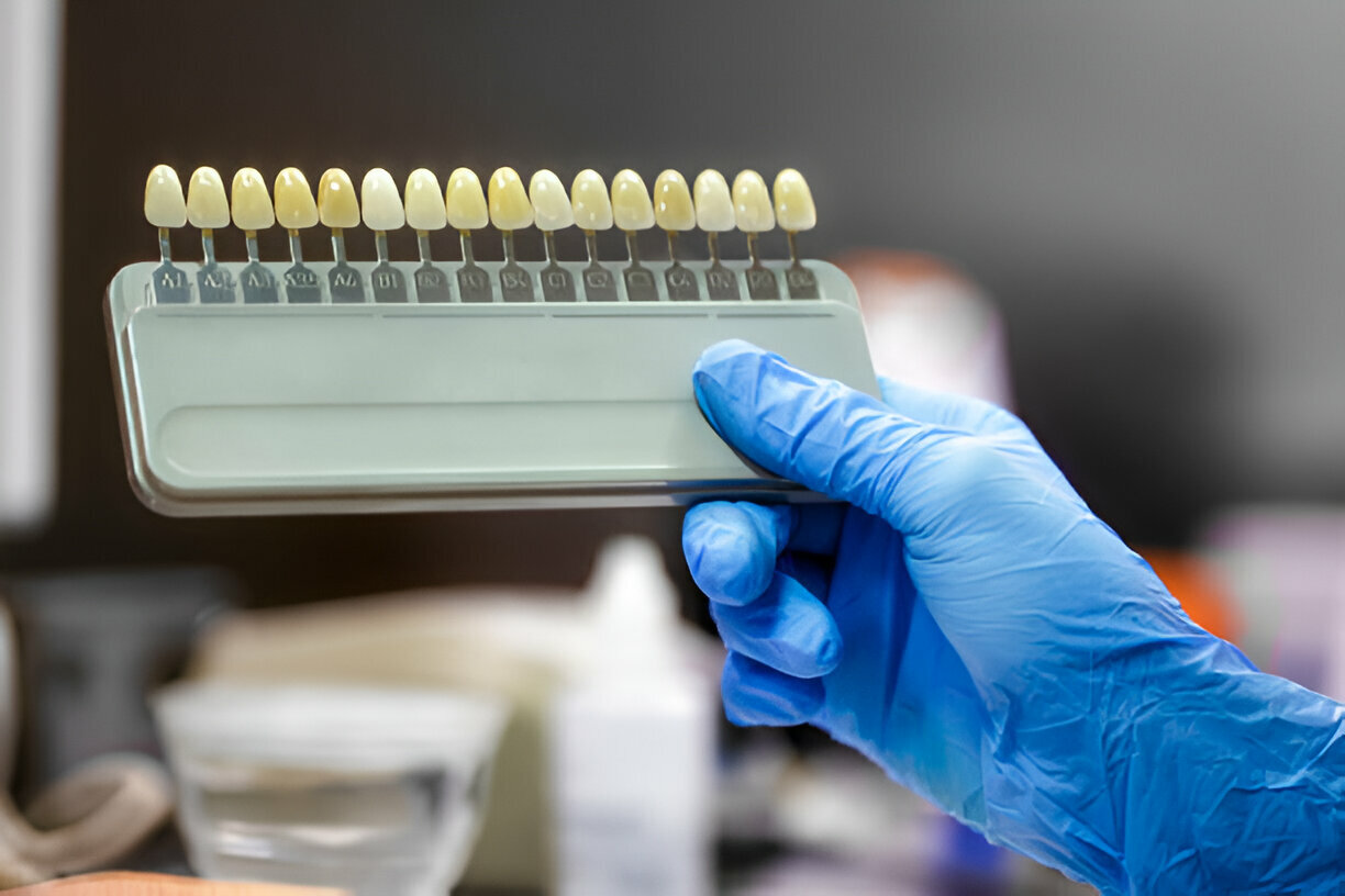 Why Shallotte Patients Choose CEREC Dental Crowns for Fast, Lasting Results_FI